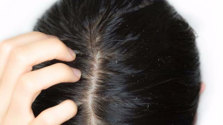 Kafa kaşıntısı neden olur?