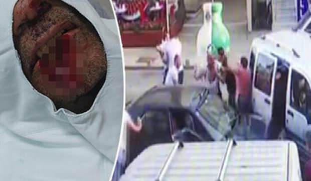 Kayınpederinin dudağını ısırıp kopardı! İşte istenen ceza