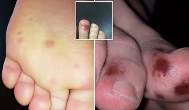 Koronavirüsün (COVID-19) yeni belirtileri olabilir! Daha çok çocuk ve gençlerde görülüyor