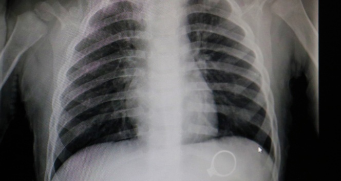 Annesinin 3 bin liralık tek taş yüzüğünü yuttu