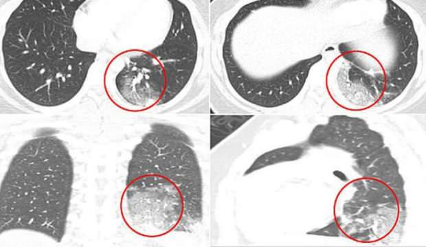 Dikkat çeken araştırma: Koronabirüs bulaşan çocuklar incelendi ve…