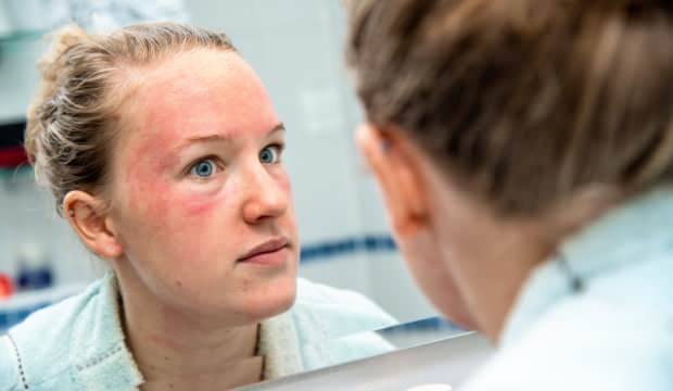 Koronavirüs deri hastalıklarına yol açtı: 5 farklı cilt sorunu ortaya çıktı