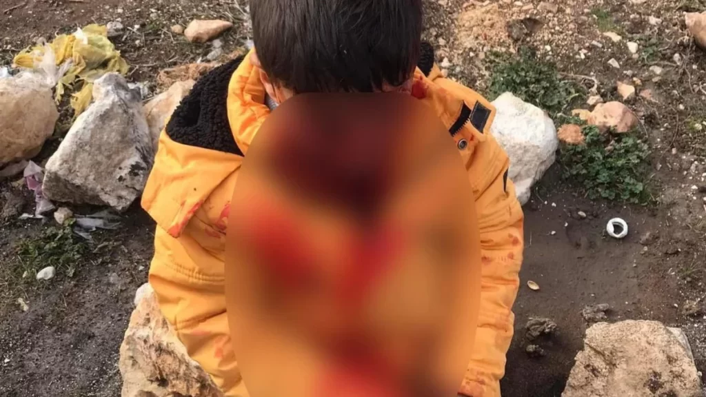 Adıyaman’da çocuğa saldıran başıboş köpek kuduz çıktı